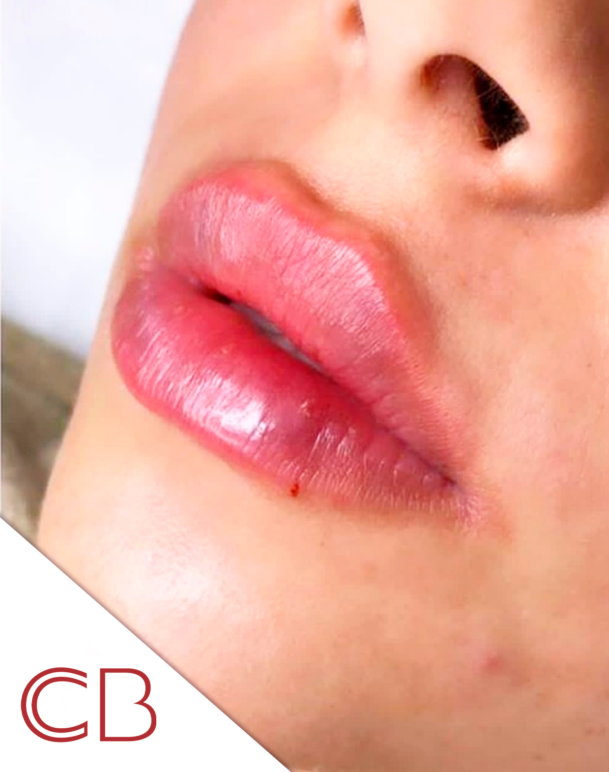 antes despues1-labios-rusos-1