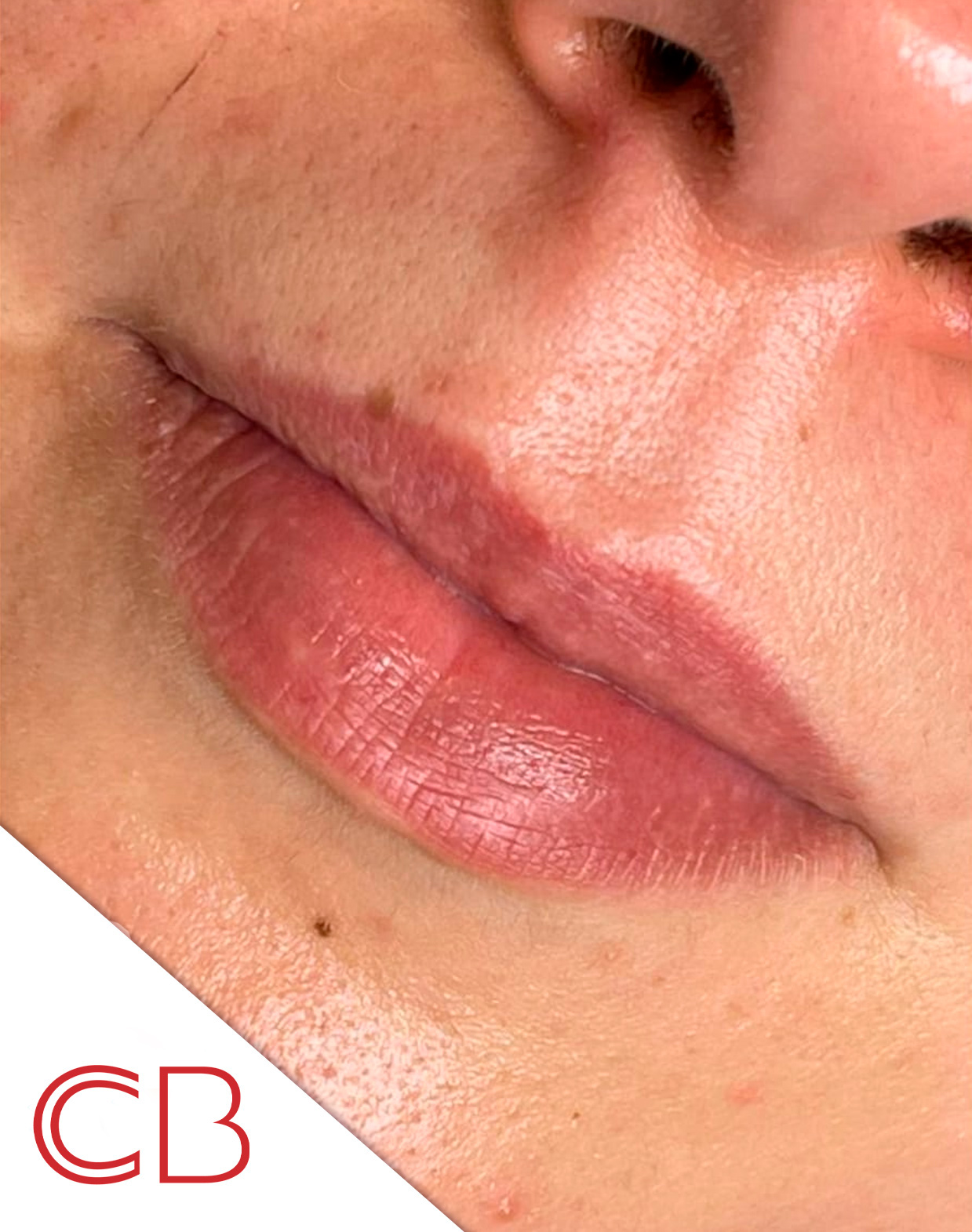 antes4 despues-labios-rusos-